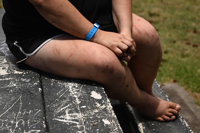 Annelise Cochran's cuts and burns.