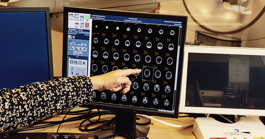 Mutation Protected Man From Alzheimer’s Disease, Hinting at Treatment