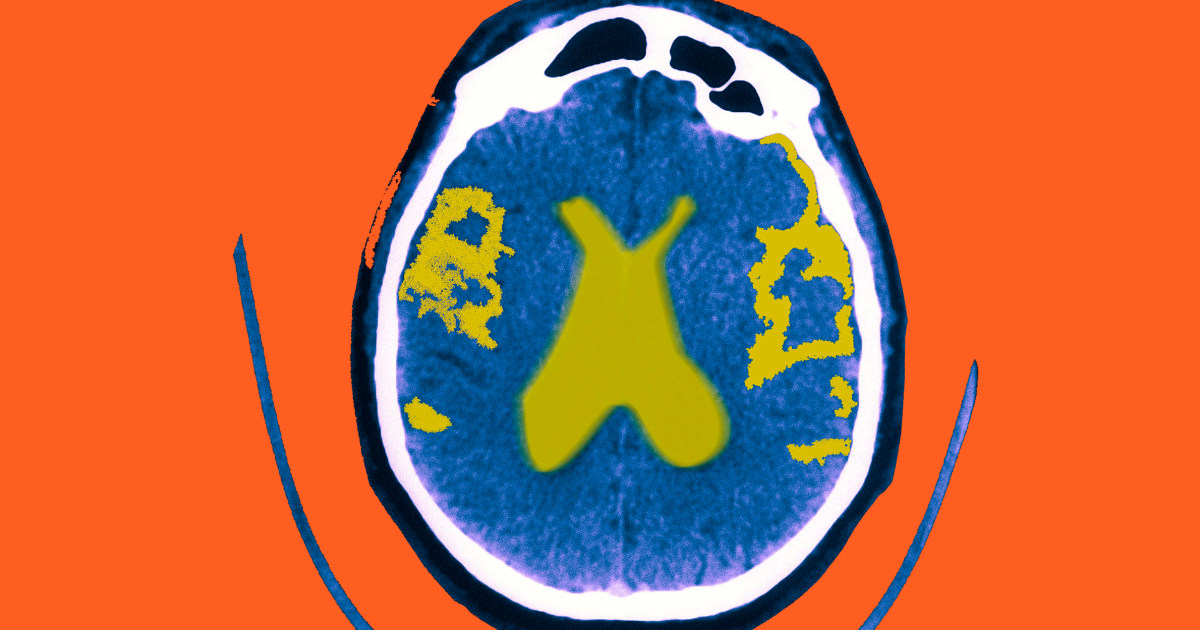 Medicare plans to pay for Alzheimer's drugs that win full FDA approval