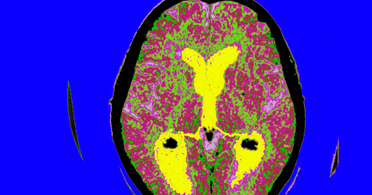 FDA grants full approval to new Alzheimer's drug meant to slow disease