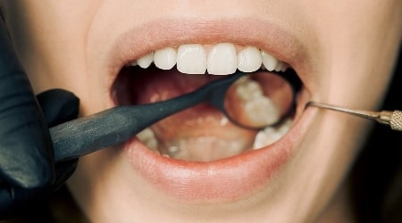 Why Do People Go For Turkey Teeth?