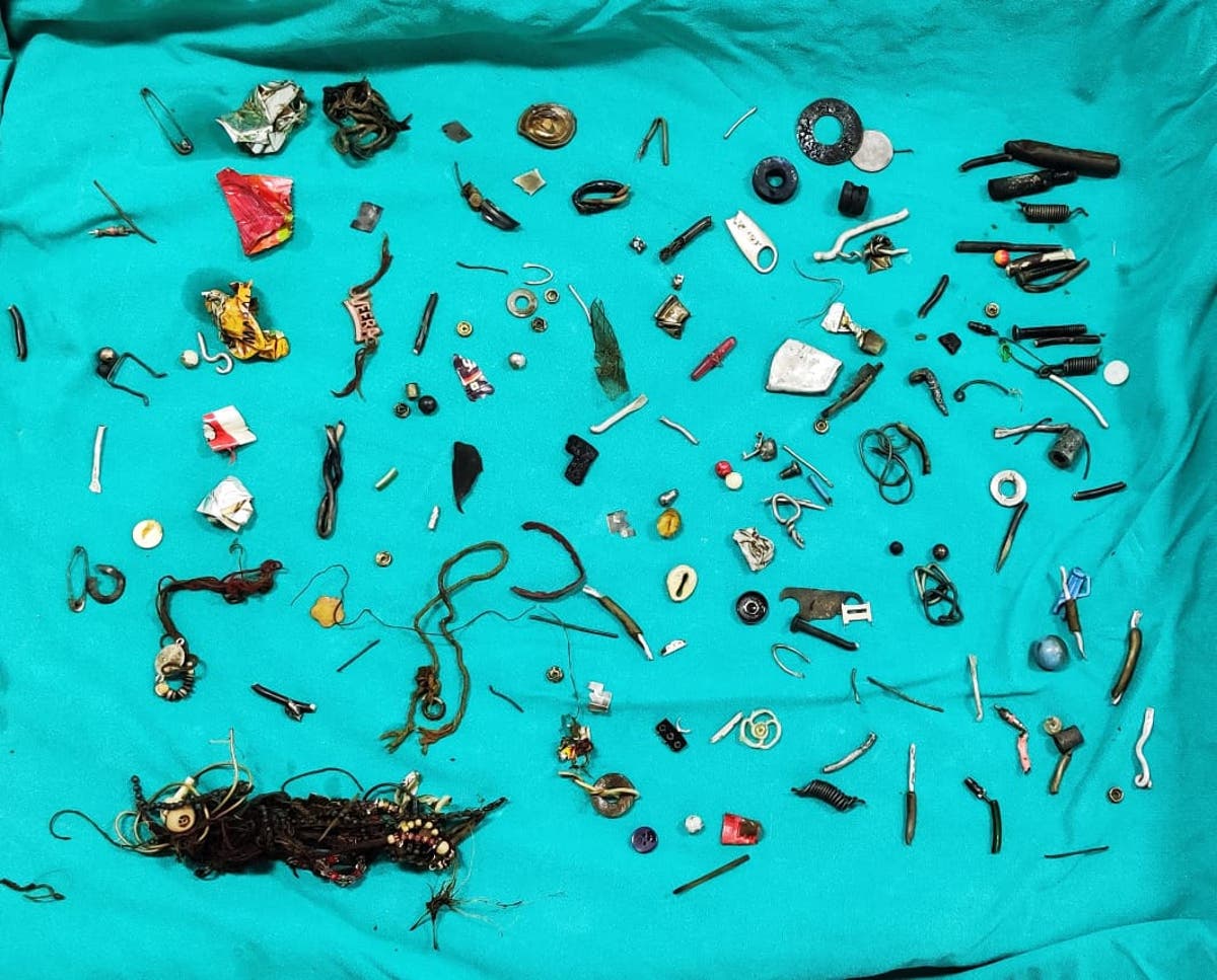 Surgeons find 150 household items in abdomen of man who complained of stomach pain