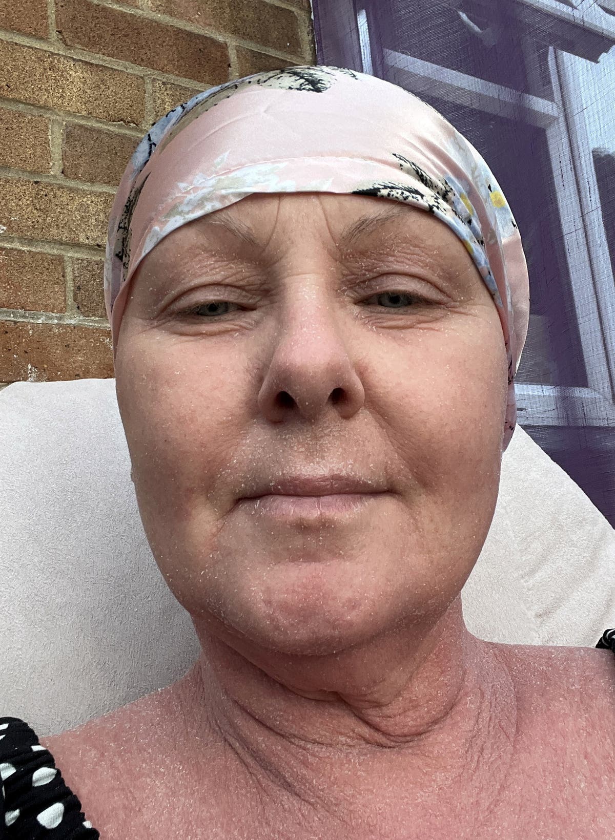 ‘Changed my life’: Woman’s hair loss hell after stopping steroid cream