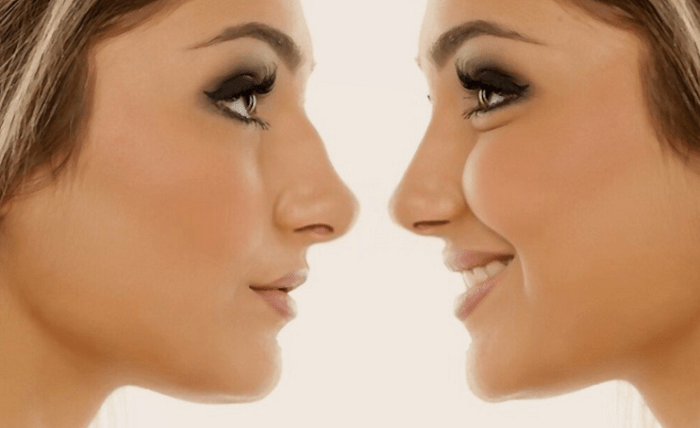 Sculpting Elegance: Navigating of Rhinoplasty in Turkey